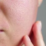 Sebum là gì? Tìm hiểu về No Sebum và Phức hợp Anti sebum P’