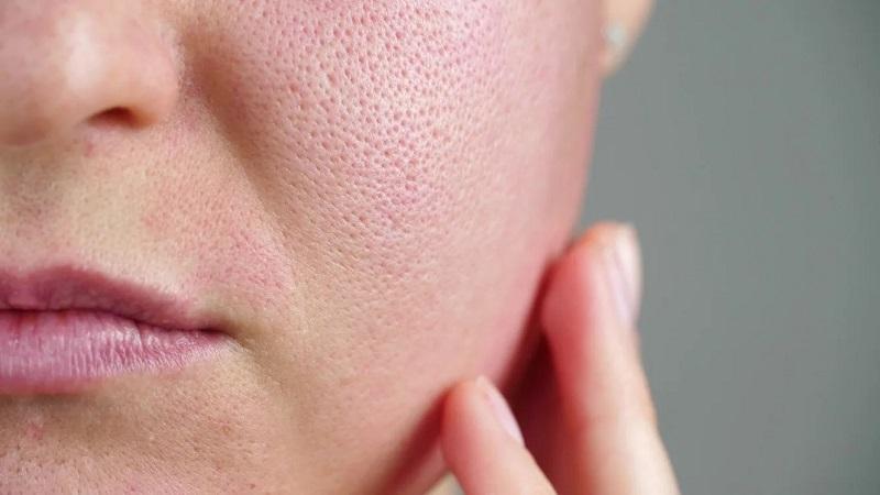 Sebum là gì? Tìm hiểu về No Sebum và Phức hợp Anti sebum P’